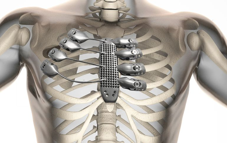Имплантация протеза грудины и рёбер (компьютерная модель: CSIRO).