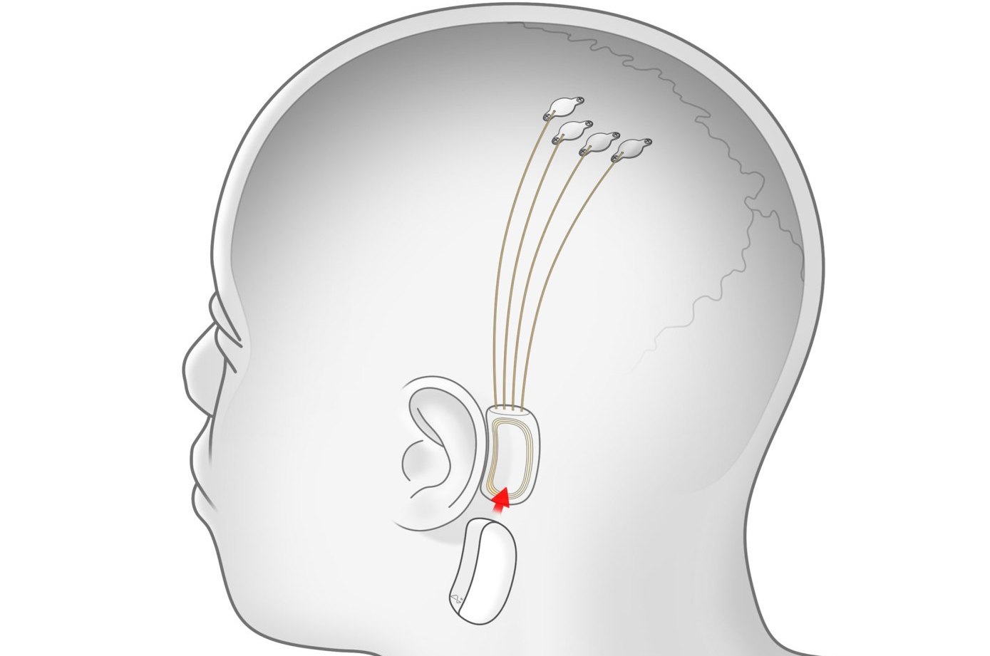 Проект Илона Маска Neuralink может начать испытания на человеке уже в следующем году 