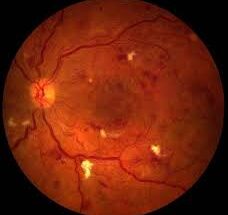 Ученые изобрели новый желтый лазер для глазной хирургии