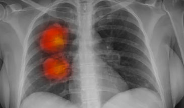 ИИ для диагностики рака тестируют в Лондоне