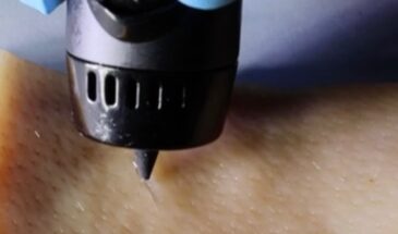 Ручка наносит лечебный гель прямо на раны