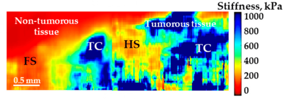 MPDI: Diagnostic Accuracy of Cross-Polarization OCT and OCT-Elastography for Differentiation of Breast Cancer Subtypes: Comparative Study